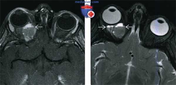 КТ, МРТ при лимфатической мальформации головы и шеи