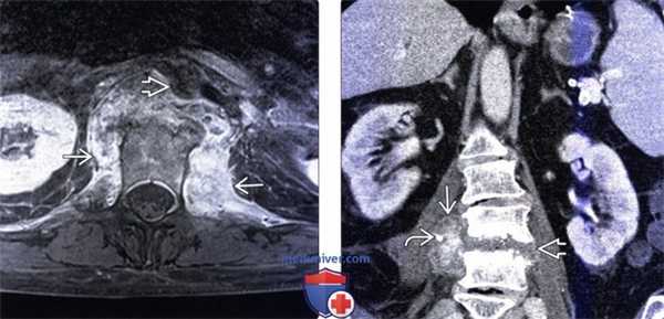 КТ, МРТ при паравертебральном абсцессе