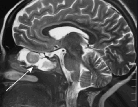 МРТ пазух носа, что показывает