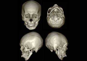 Симптомы, лечение и причины гемифациальной микросомии