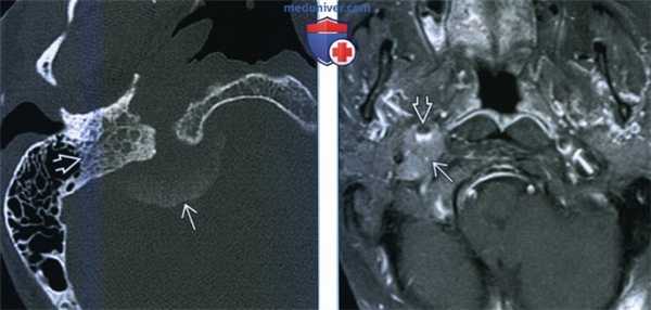 Менингиома сонного пространства - лучевая диагностика