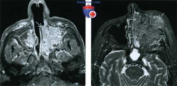 КТ, МРТ при синоназальной инвертированной папилломе