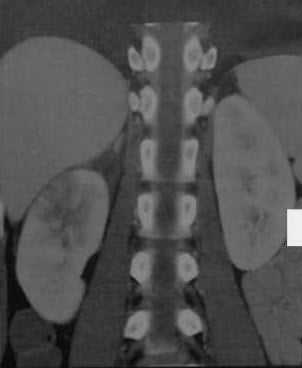 Снимки МРТ и КТ. Острый пиелонефрит