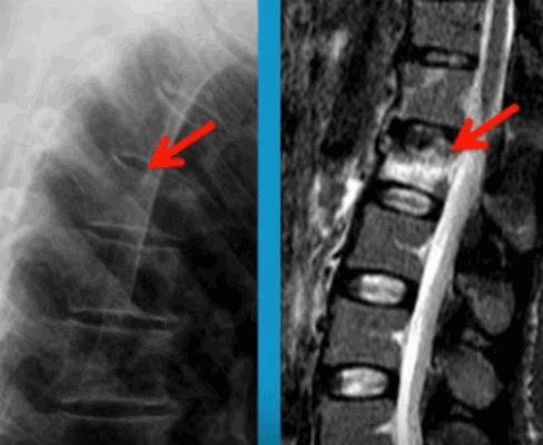 Перелом позвоночника