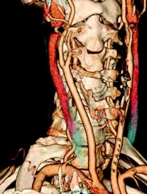 МСКТ артерий шеи и головы - высокоинформативный метод диагностики