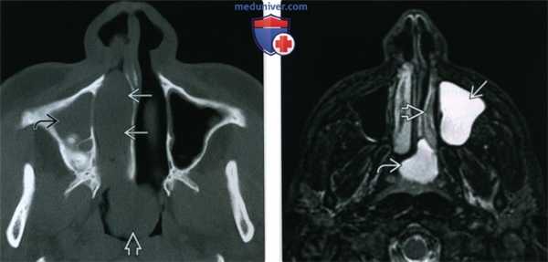 КТ, МРТ при солитарном полипе носа, пазухи