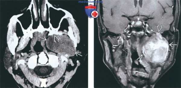Лучевая диагностика шванномы жевательного пространства
