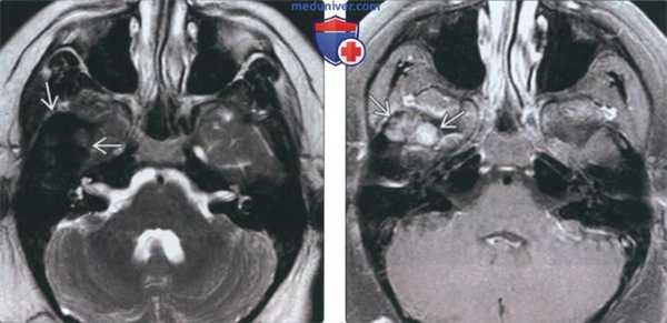 Лучевая диагностика пигментного ворсинчато-узлового синовита височно-нижнечелюстного сустава (ВНЧС)