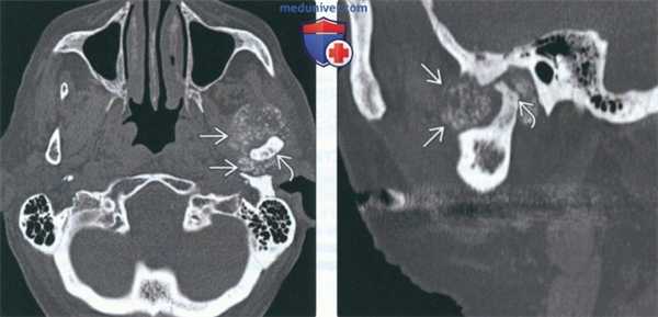 КТ, МРТ при хондросаркоме жевательного пространства