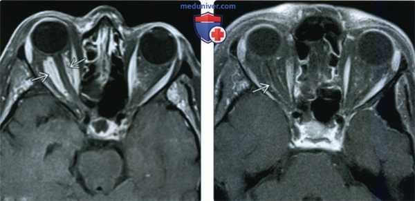 КТ, МРТ при идиопатическом воспалении глазницы (псевдотуморе)