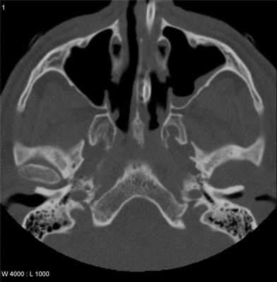 КТ височно-нижнечелюстных суставов