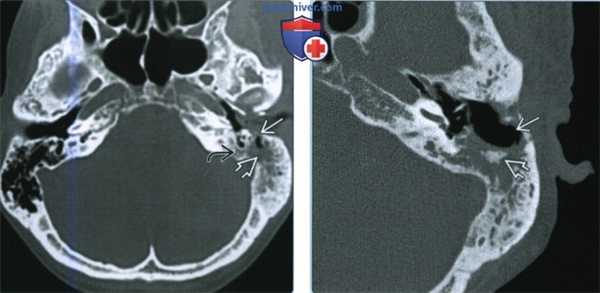 Остеорадионекроз височной кости - лучевая диагностика