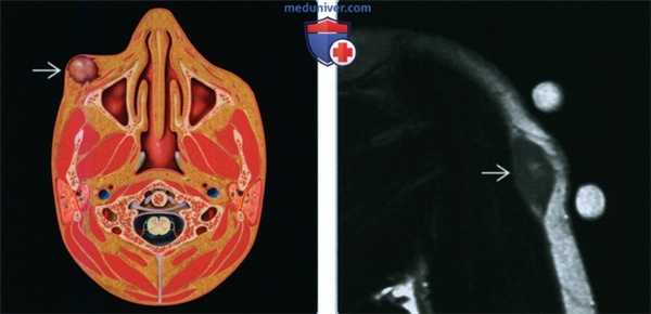Глубокая доброкачественная фиброзная гистиоцитома - лучевая диагностика