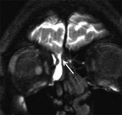 МРТ-фистулография