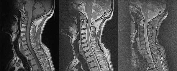 Какие заболевания покажет МРТ мягких тканей шеи