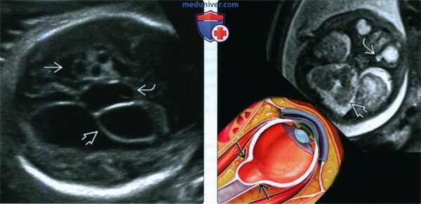 Лучевые признаки колобомы у плода