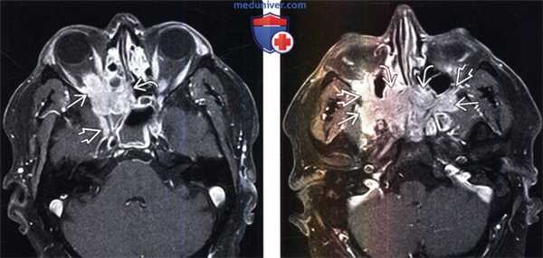 Внутричерепной идиопатический воспалительный псевдотумор на МРТ