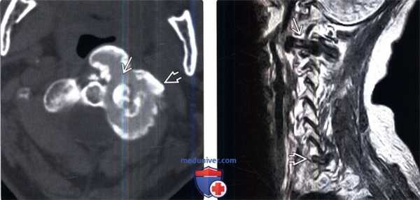 КТ, МРТ при опухолевом кальцинозе позвоночника
