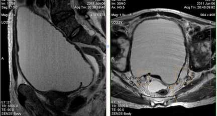 МРТ малого таза в диагностике заболеваний мочевого пузыря
