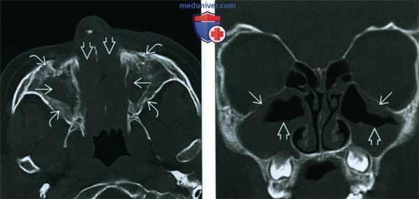 КТ, МРТ при хроническом риносинусите