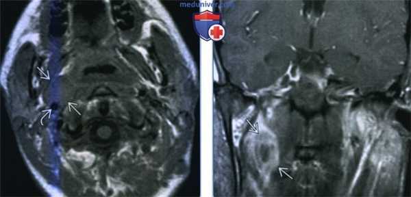Неходжкинская лимфома заглоточных лимфоузлов - лучевая диагностика