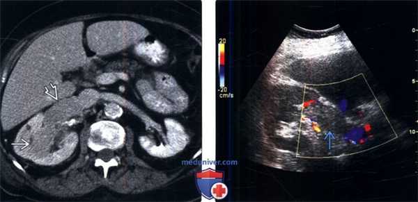 КТ, МРТ при тромбозе почечной вены