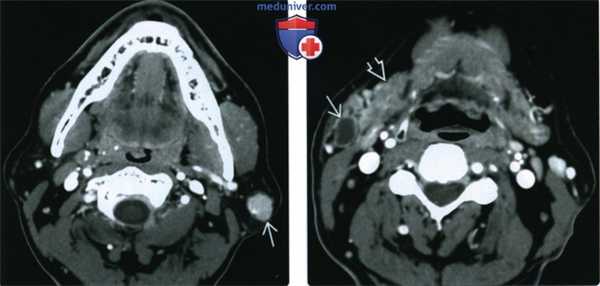 КТ, МРТ при опухоли Вартина