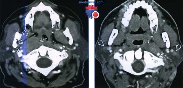 Неходжкинская лимфома заглоточных лимфоузлов - лучевая диагностика