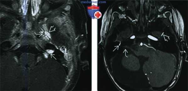 Младенческая гемангиома и синдром PHACES - лучевая диагностика