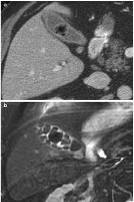Вид конкрементов у одного и того же пациента в желчном пузыре при КТ (а) и МРТ (b)
