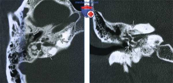 Отосифилис - лучевая диагностика