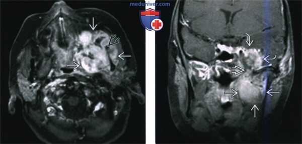 КТ, МРТ при саркоме жевательного пространства