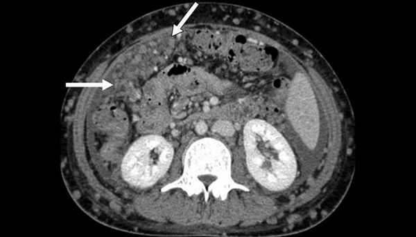 Канцероматоз брюшины, компьютерная томография