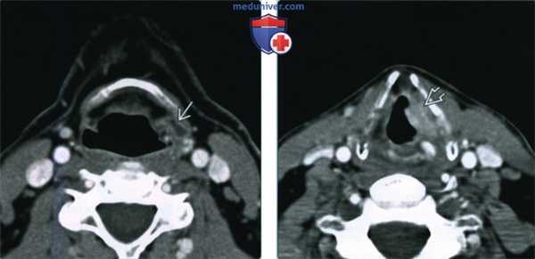 Плоскоклеточный рак гортани с ларингоцеле - лучевая диагностика