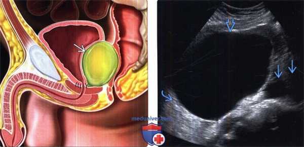 КТ, МРТ, УЗИ при послеоперационном лимфоцеле
