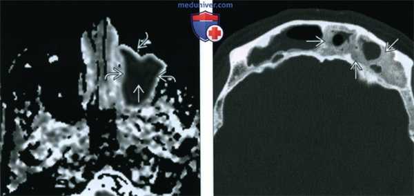 КТ, МРТ при хроническом риносинусите