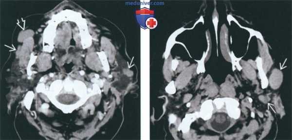 КТ, МРТ при опухоли Уортина