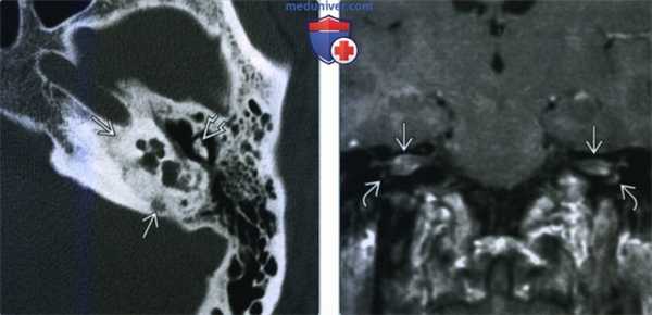 Отосифилис - лучевая диагностика