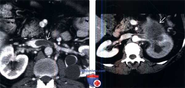 КТ, МРТ при тромбозе почечной вены