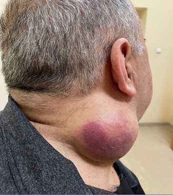 Плеоморфная саркома мягких тканей шеи справа