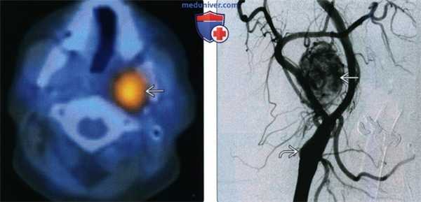 КТ, МРТ при вагальной параганглиоме