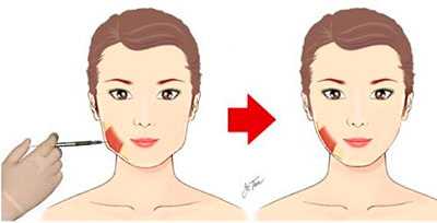 Ботулинотерапия при гипертрофии жевательных мышц