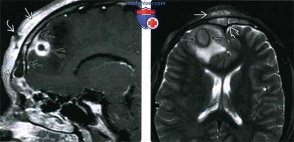 КТ, МРТ при осложнениях риносинусита