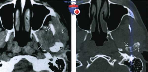 КТ, МРТ при хондросаркоме жевательного пространства