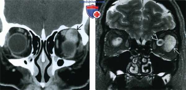 КТ, МРТ при кавернозной венозной мальформации глазницы (гемангиоме)