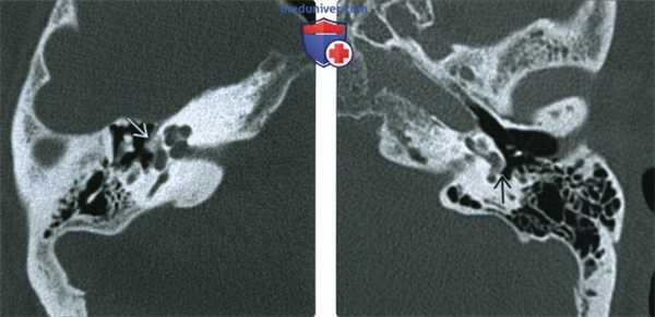 КТ, МРТ при отосклерозе