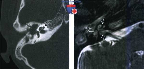 КТ, МРТ при оссифицирующем лабиринтите