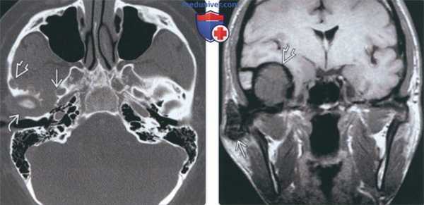 Лучевая диагностика пигментного ворсинчато-узлового синовита височно-нижнечелюстного сустава (ВНЧС)