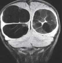 эхинококк головного