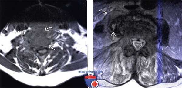 КТ, МРТ при паравертебральном абсцессе